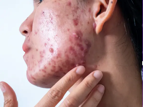 Akne ve Sivilce Hakkında Kapsamlı Rehber